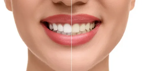 Teeth Whitening Near Me Your Complete Guide to a Brighter, Whiter Smile